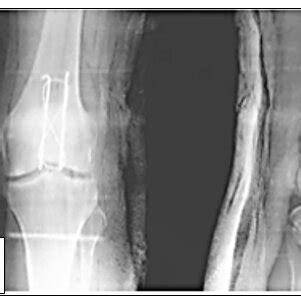 Pdf Technique Of Tension Band Wiring In Patella Fracture Management