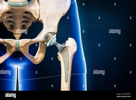 Proth Se De Hanche Ou Implant Isol Sur Fond Bleu Avec Espace De Copie