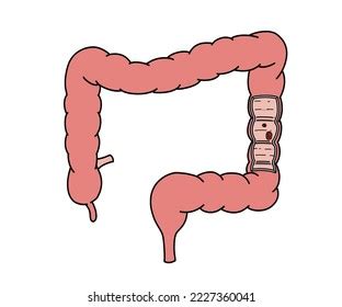 Colorectal Cancer Medical Drawing Materials Stock Illustration