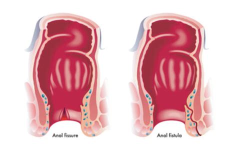 Leading Anal Fissure Treatment Center In Rohini Maple Entertainment