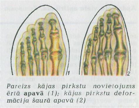 APAVI | Medicīnas termins
