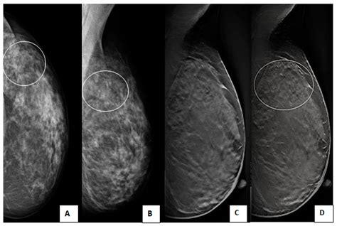 The Impact Of Adding Digital Breast Tomosynthesis To Bi Rads