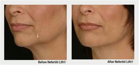 Boulder Bliss Medical Spa Nefertiti Lift Consult