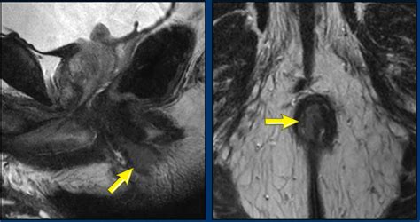 The Radiology Assistant Anal Cancer Staging