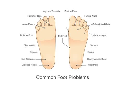 Common Foot Problems