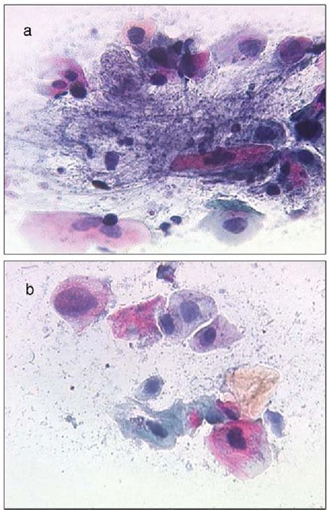 Figure From Anal Cytology As A Screening Tool For Early Detection Of Anal Dysplasia In Hiv