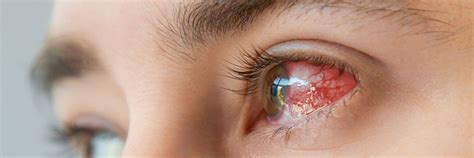 The Most Common Eye Infections