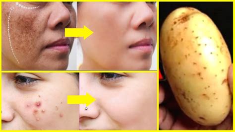 How To Remove Pimples Overnight Acne Treatment At Home Dark Spots