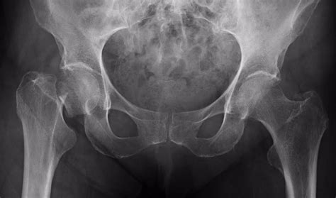 Expertos Recomiendan El Tratamiento Para La Osteoporosis En Mayores De