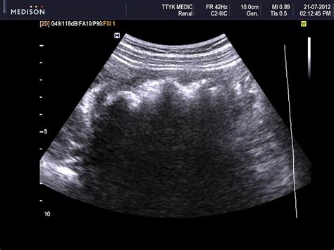 Cancer Diagnosis: Ultrasound For Colon Cancer Diagnosis