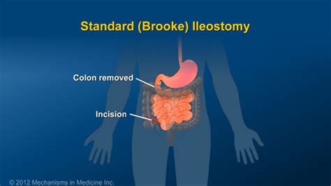 What Is An Ileostomy