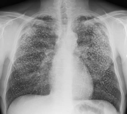 Silicosis Radiology Reference Article Radiopaedia Org