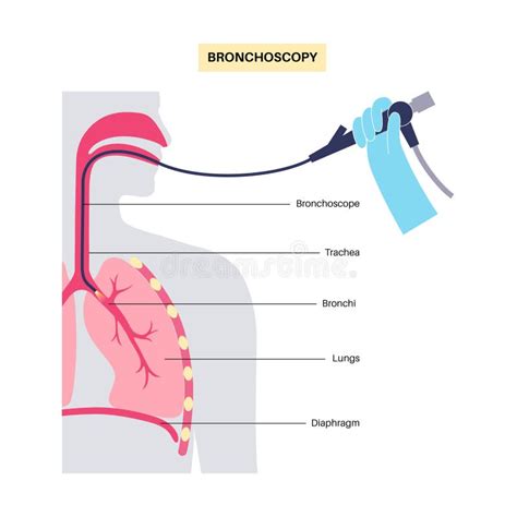 Bronchoscopy Procedure Concept Stock Vector Illustration Of Anatomy