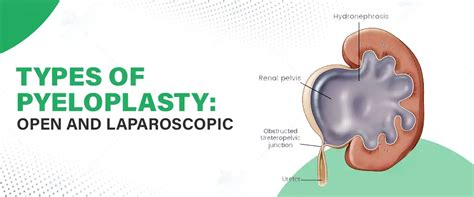 types  pyeloplasty open  laparoscopic