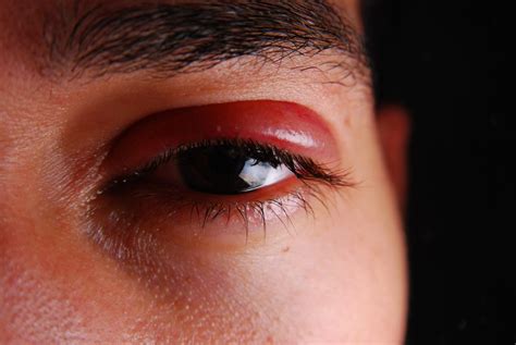 Olhos inchados 8 dicas para aliviar o incômodo