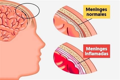 Meningitis Qu Es S Ntomas Causas Y Tratamiento Tua Sa De