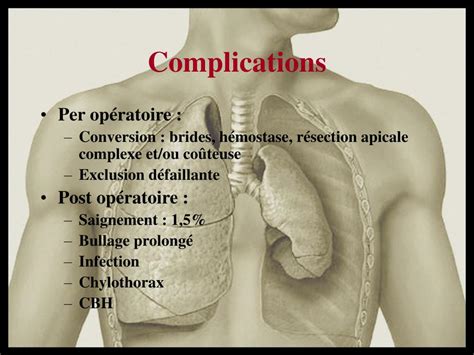 Ppt Traitement Chirurgical Du Pneumothorax Spontan Powerpoint