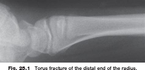 Figure 251 From Radiographic Evidence Of Supracondylar Fractures