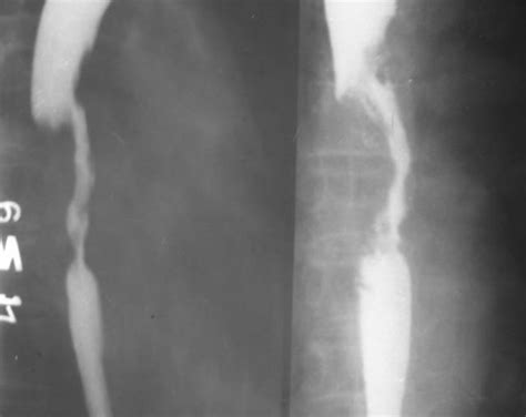 Esophageal Cancer Barium Swallow