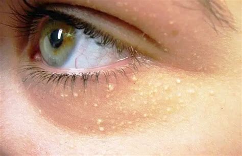 White Spots Under Eyes
