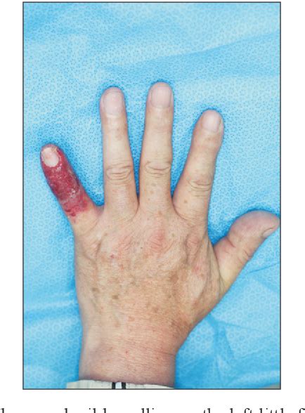 Table 1 From Staphylococcal Scalded Skin Syndrome In A Healthy Adult Easy To Misdiagnose