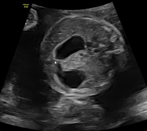 Ultrasound Image Of The Duodenal Atresia Double Bubble Observed In