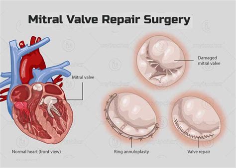 Mitral Valve Prolapse Part 2 The Valve Mitral Valve M - vrogue.co