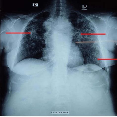 Anteroposterior Chest X Ray Image Showing Homogeneous Opacities Over Download Scientific