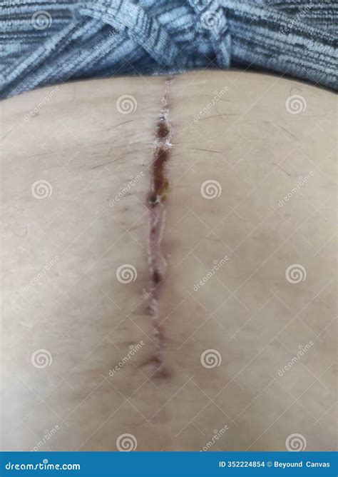 Abdominal Hysterectomy: Recovery and Healing Stock Photo - Image of