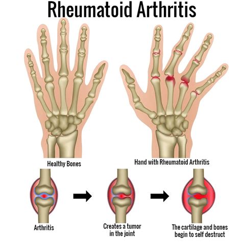 Rheumatoid Arthritis Causes Of Flare Ups at Vaughn Gurule blog