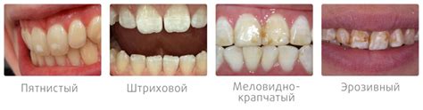 Флюороз зубов: лечение, диагностика и профилактика пятен на эмали — ROOTT
