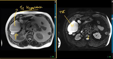 Gi Imaging Fellowship Certificate Online Radiology Course Mri