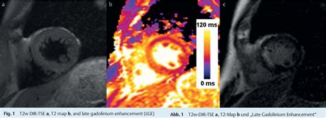 Figure 1 From Cardiac MRI T2 Mapping Versus T2 Weighted Dark Blood TSE