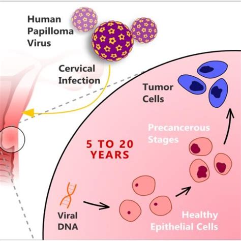 normal cervix undergoes precancerous stage  finally turns