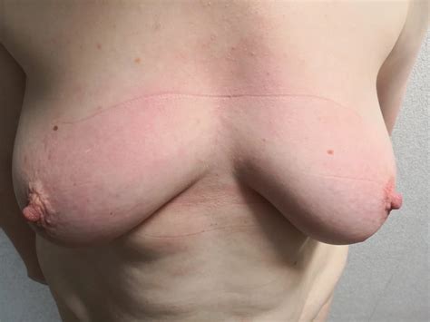 Squeezing Tits The Hard Way 18 Nude Pics XHamster