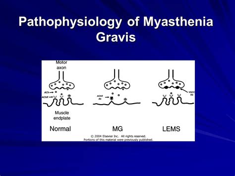 Myasthenia gravis and antibiotics use