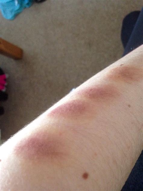 Handprint Bruise On Arm
