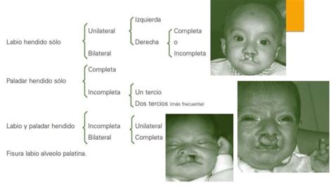 Labio Y Paladar Hendido Genetica Clinica