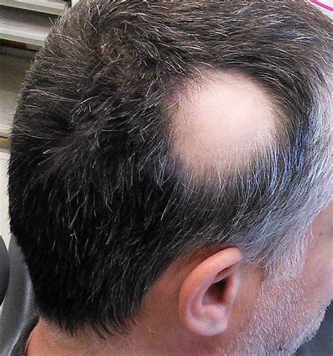 Alopecia causas síntomas factores y cómo detectarlos a tiempo