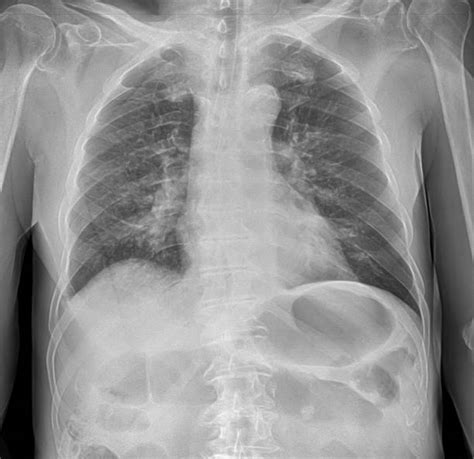 Lung Scarring Stock Photos Pictures And Royalty Free Images Istock
