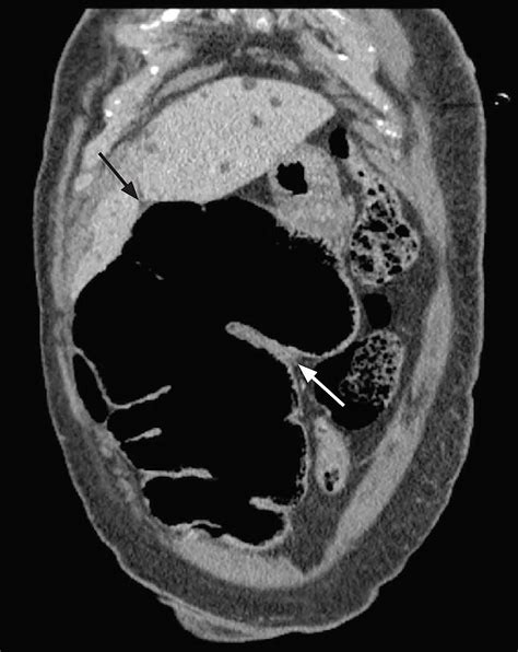 An Unlikely Cause Of Abdominal Pain The Western Journal Of Emergency