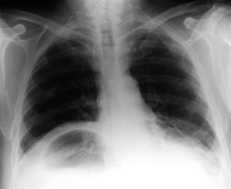 Chest X Ray On Admission Showing An Unusual Air Fluid Level In The