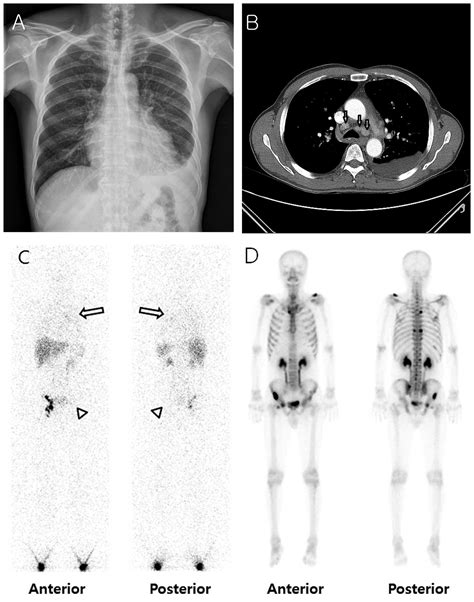 Metastatic prostate cancer initially presenting as chylothorax: A case