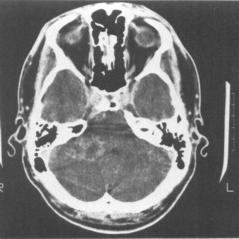 A Preoperative Axial Ct Scan With Contrast In Case Demonstrating A