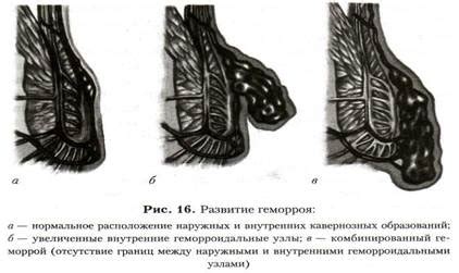 ГЕМОРРОЙ