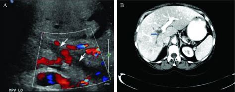 Diagnosis And Management Of Portal Vein Thrombosis In Patients With