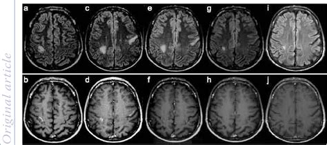 Figure 1 From Central Nervous System Immune Reconstitution Disease Presenting With Vasculitis