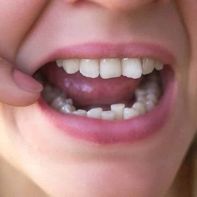 How Long Do Braces Take To Straighten Crowded Teeth In Dubai