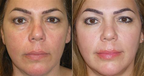 Eyelid Surgery Blepharoplasty Turkey Blepharoplasty Surgery Cost