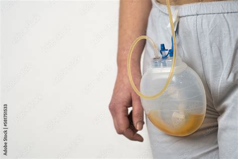Surgical Drainage On A Patient Filled With Drained Serous Yellow Fluid